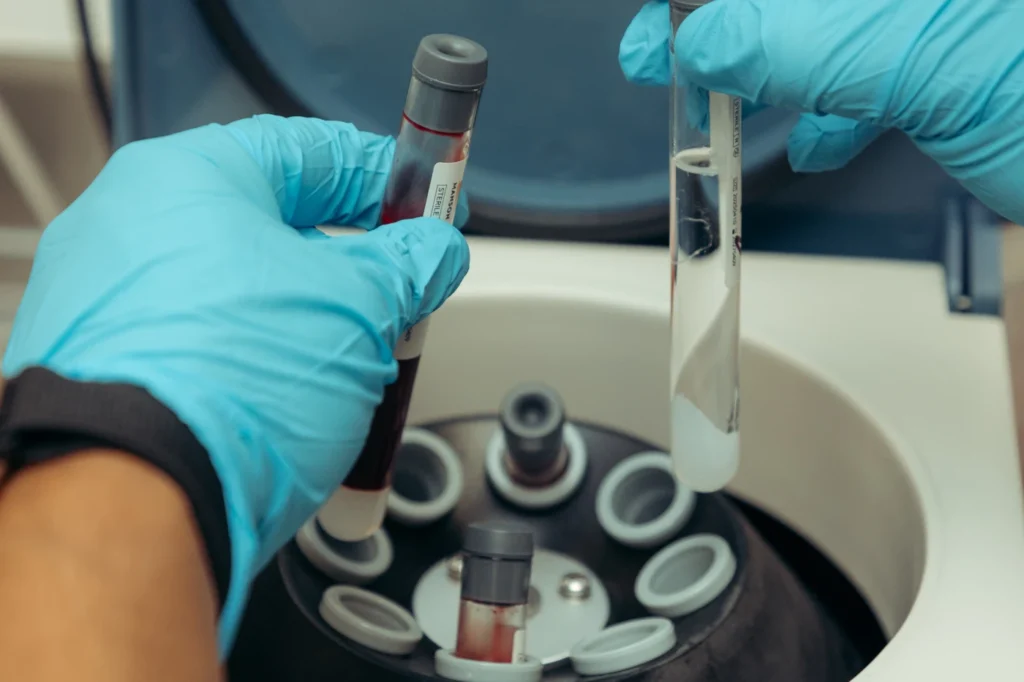 Close-up shot of PRP therapy perparation