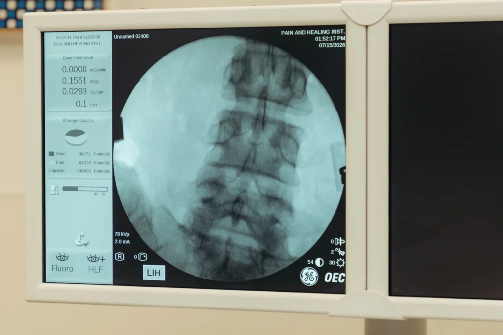 fluoroscopy of the lumbar spine, analysis before Radiofrequency Ablation